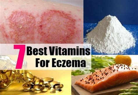 best vitamin for eczema|vitamins for eczema in adults.